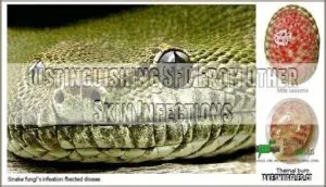 distinguishing sfd from other skin infections distinguishing sfd from other skin infections