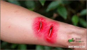 snakebite symptoms and diagnosis snakebite symptoms and diagnosis
