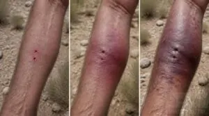 what rattlesnake bites look like in pictures what rattlesnake bites look like in pictures
